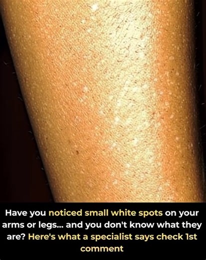Have you noticed small white spots on your arms or legs… and you don't know what they are? Here's what a specialist says check 1st comment👇 | American Recipes