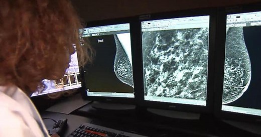 "Great news" for many breast cancer patients