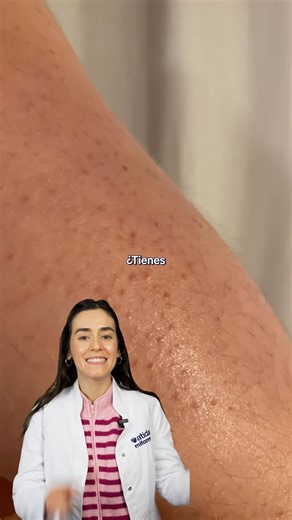 ¿Tienes estos granitos en los brazos y no se van nunca? 👀 ❌ No es acné, no es alergia 👉 Es queratosis pilaris, una condición muy frecuente. Se produce cuando la queratina (una proteína natural de la piel) se acumula en exceso y tapa el folículo del vello, formando pequeños tapones. Esto da lugar a esos granitos duros, del color de la piel o ligeramente rojos, con un tacto áspero tipo “piel de gallina”. 📍 Suele aparecer en: Brazos (cara externa) Muslos Glúteos A veces mejillas 🧬 Tiene un comp