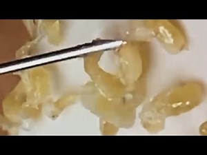 Extraction profonde des points noirs Acné kystique et popping #16