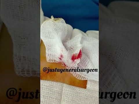 Dermatofibroma excision