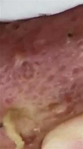Had this pimple for over 5 years 😵‍💫