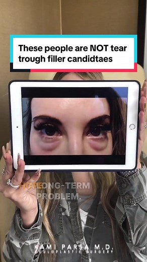 ⚠️Not everyone is a tear trough filler candidate. Here are 5 examples of the types of patients who are NOT tear trough filler candidates. (Tear trough filler can make things worse if you are not the right candidate for it.) #eyebags #holloweyes #learntok #teartrough #filler #fillers #trifectalift