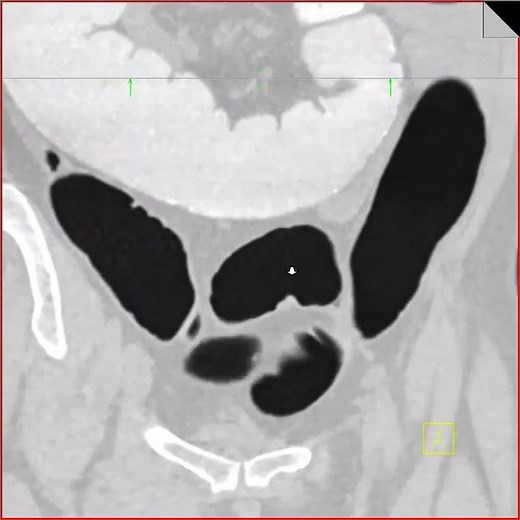 Virtual colonoscopy with polyp in sigmoid colon