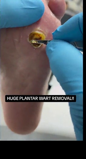 Giant Plantar Wart Removal Process