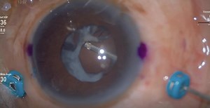 Pars Plana Lensectomy for Traumatic Cataract With Resorbed Nucleus - Eyetube