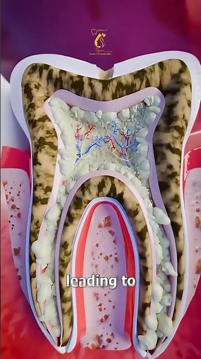 How a Tooth Abscess Forms!