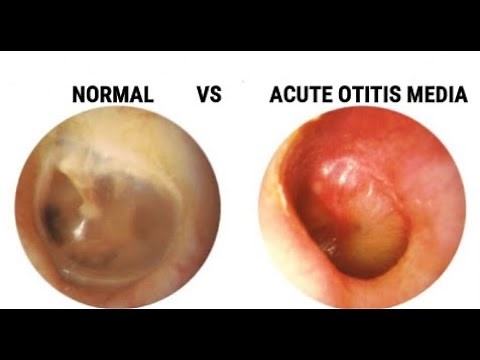 Acute Otits Media vs Normal Ear and More