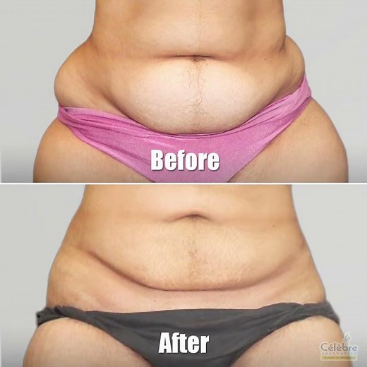 Life-Changing Liposuction Transformation: Witness the Astonishing Before & After!