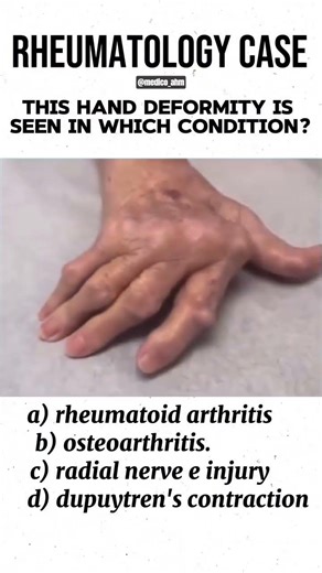 This hand deformity is a Claw Hand (or intrinsic minus hand),