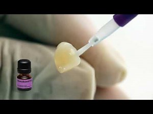 IVOCLAR - Multilink Automix: Cementazione di un onlay IPS e.max Press