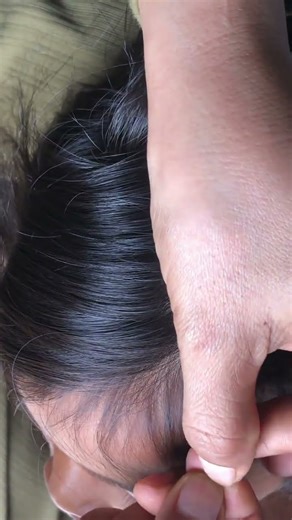 bad lice removal part 176 #love #vira #for #fyp