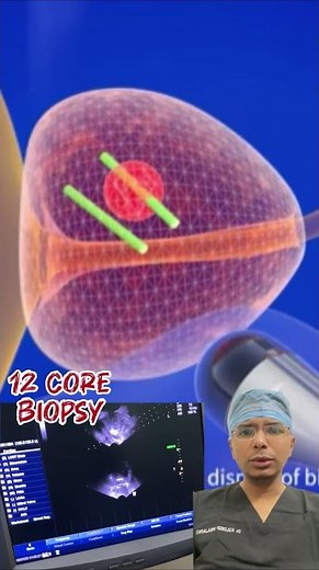 A transrectal ultrasound guided prostate biopsy. #urologist #urologyhealth #prostatecancertreatment