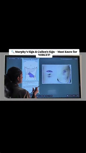 Nursing Tech Jyoti on Instagram: "Murphy’s sign 👉 Acute Cholecystitis Cullen’s sign 👉 Hemorrhagic Pancreatitis 📌 High-yield clinical signs you cannot miss for NORCET mains & AIIMS exams! Save 🔖 + Share 🤝 = Revision made easy ✨ #NorcetPrep #Norcet9 #NursingExam #MurphySign #CullenSign #HighYield #MedicalSigns #NursingStudents #NursingReels #NorcetMains #AIIMSExam #NursingMotivation #ExamRevision #StudyWithMe"