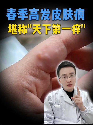 春夏换季，手上长米粒大小的透明小水泡，痒到钻心！这是汗疱疹 ，别再乱治了，医生教你在家处理！