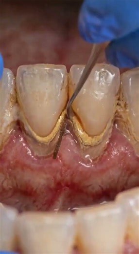 The Plaque That Built a House | Extreme Tartar Removal Transformation #shorts