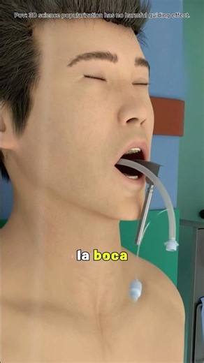 Laryngeal Lesion Removal (3D Animation) | Vocal Cord Repair Surgery#Health#3D#Surgery#Animation