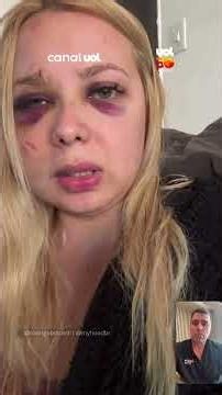 Woman assaulted on São Paulo subway says she has lost vision in one eye