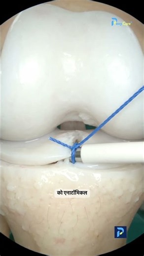 Miniscus repair