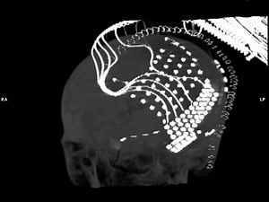 Recording Human Electrocorticographic ECoG Signals for Neuroscientific Research and Real-time Functional Cortical Mapping