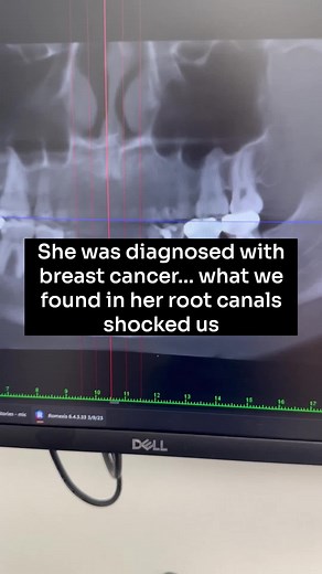 Understanding Root Canals and Hidden Infections