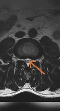Filum Terminale Lipoma