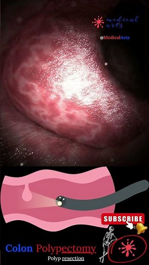 Coloscopy | Colon Polyp Resection | Polypectomy