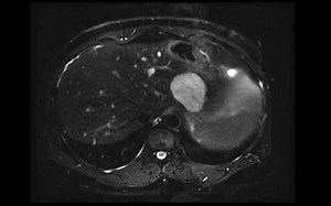 078 （肝脏外生性血管瘤）Exophytic hepatic hemangioma_哔哩哔哩_bilibili