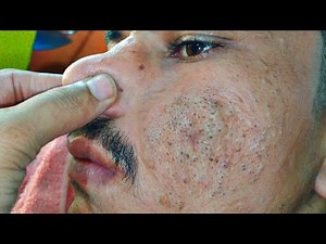 sac be spa blackheads elderly 2025 | sac be spa boy age blackhead today | ASMR sacbespa scrub facial