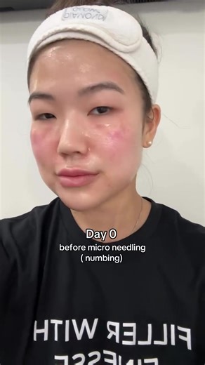 Ever wonder what microneedling looks like after the appointment? SkinPen works by creating controlled micro-injuries that trigger collagen production and help improve texture, tone, and fine lines. Redness and sensitivity right after treatment are normal, then the skin gradually calms as healing kicks in. Healing can look different for everyone, but this gives a realistic look at what recovery can feel like and why microneedling remains a go-to for skin quality. #ItsASecretMedSpa #Microneedling 