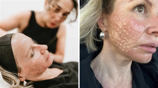 Jay Hanna trials the viral salmon sperm facial