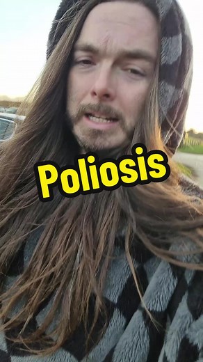 Poliosis: Understanding the Mallen Streak in Hair