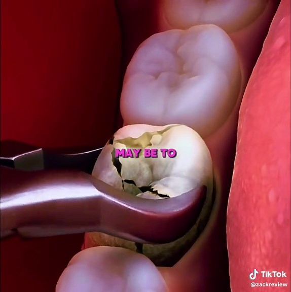 How Dentists Repair A Split Tooth 😬 #zackdfilms #animation #3danimation #didyouknow #fyp