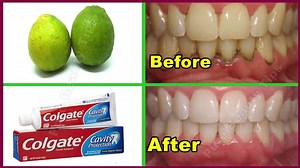 67K views · 1.5K reactions | Teeth Whitening Remedy ! Get whiten Teeth at home in 2 minutes ! WITH Colgate And Lemon | Pure Beauty Tips | Facebook