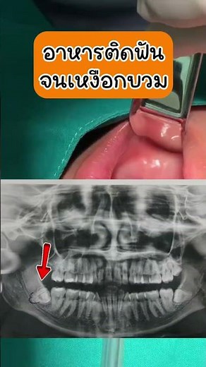Food particles stuck in your wisdom tooth causing gum swelling? What to do? Come to #TheDent wher...