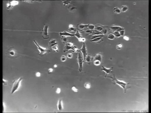 显微镜下的癌细胞