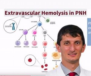 Did you miss this webinar? Dr. Taha Bat explains extravascular hemolysis, focusing on PNH (Paroxysmal Nocturnal Hemoglobinuria). Watch the recording here: https://www.aamds.org/education/patient-family-webinars #PNH #EVH | Aplastic Anemia and MDS International Foundation | Facebook