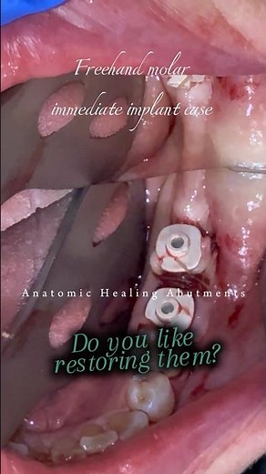Do you like restoring Straumann AHA?