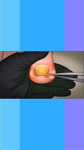 thumb treatment nail cleaning treatment Asmr animationt#asmr#nailcleaning#treatment#asmranimation