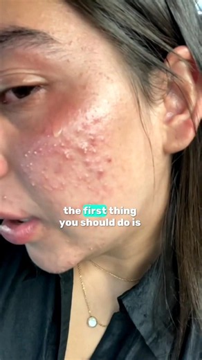 pov : you have acene skin watch this #skincare