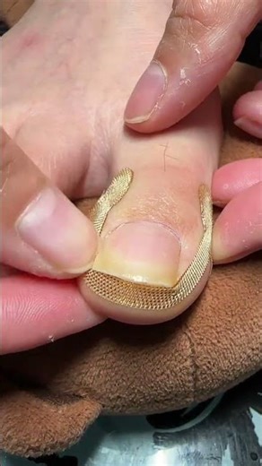 Ingrown Toenail Correction | Foot Care | Nail Treatment Shorts 👣
