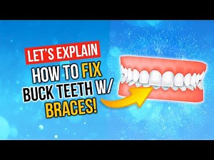 How Long Does It Take To Treat A MINOR OVERBITE?!