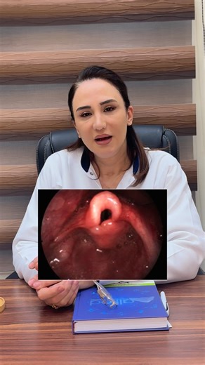 Dr dima alali on Instagram: "Laryngomalacia is the most common cause of noisy breathing (stridor) in infants, caused by soft, floppy cartilage in the larynx that collapses over the airway during inhalation. It typically presents in the first few weeks of life, with symptoms worsening when crying, feeding, or lying on the back. While it usually resolves on its own by 12–20 months, severe cases may require surgery"