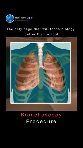 Medical | Science | Life | Discover Bronchoscopy: An in-depth look at this crucial diagnostic tool used to examine the airways and lungs. Learn about the procedure,... | Instagram