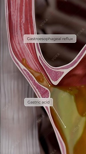 Erosive Esophagitis 3D Animation: Causes, Symptoms & Treatment | GERD, Acid Reflux
