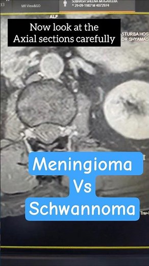 IDEM tumors. differentiating a spinal meningioma from spinal Schwannoma on MRI #SPINETUMOR