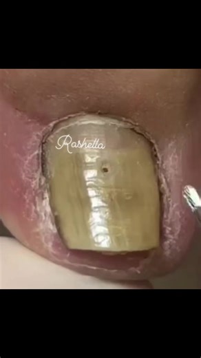 Sua dose diária de relaxamento ...🪴😎 ​#unhaencravadal ​#podologia ​#cravoseespinhas ​#skincare ​#extracaodecravos