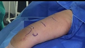 Posterior MIPO for humerus diaphyseal fractures with extra-articular distal humeral anatomical plate