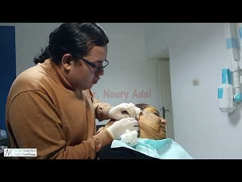 Neck lift using the Double Needle ( Thread lifting ) - Dr. Noury Adel