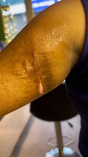 Burn scars fade, but art makes them beautiful_❤️ Follow Me For More Video👍 Book 📲9088288298